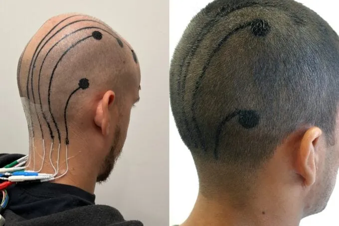 The image shows a man from the back, his head is the focal point. His head is marked with several black circular electrodes attached with thin wires connected to a device out of frame. The background is simple, a plain white wall, suggesting a clinical or medical setting. In the foreground, we can see part of the man's dark-colored clothing, which might be a sweatshirt or jacket. The precise placement and arrangement of the electrodes suggest a specific type of EEG (electroencephalography) or similar brain mapping test. The meticulous taping of the wires to the back of his head also indicates a level of precision in the procedure. The slightly visible stubble on his neck shows that he may have recently shaved for the procedure, indicating some preparation for a medical assessment.